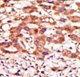 MGAT / GLYT1 Antibody - Formalin-fixed and paraffin-embedded human cancer tissue reacted with the primary antibody, which was peroxidase-conjugated to the secondary antibody, followed by AEC staining. This data demonstrates the use of this antibody for immunohistochemistry; clinical relevance has not been evaluated. BC = breast carcinoma; HC = hepatocarcinoma.