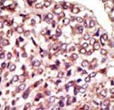 MGAT / GLYT1 Antibody - Formalin-fixed and paraffin-embedded human cancer tissue reacted with the primary antibody, which was peroxidase-conjugated to the secondary antibody, followed by AEC staining. This data demonstrates the use of this antibody for immunohistochemistry; clinical relevance has not been evaluated. BC = breast carcinoma; HC = hepatocarcinoma.