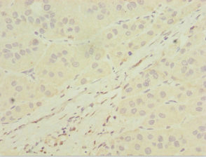 MGAT / GLYT1 Antibody - Immunohistochemistry of paraffin-embedded human liver cancer at dilution 1:100