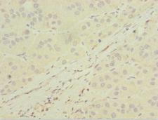 MGAT / GLYT1 Antibody - Immunohistochemistry of paraffin-embedded human liver cancer at dilution 1:100