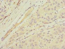 MGAT / GLYT1 Antibody - Immunohistochemistry of paraffin-embedded human liver cancer at dilution 1:100