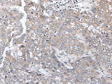 MGC11296 / BRMS1L Antibody - Immunohistochemistry of paraffin-embedded Human liver cancer tissue  using BRMS1L Polyclonal Antibody at dilution of 1:45(×200)