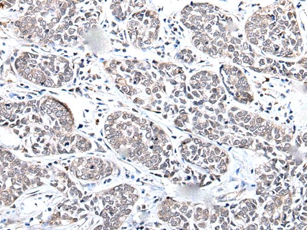 MGC11296 / BRMS1L Antibody - Immunohistochemistry of paraffin-embedded Human esophagus cancer tissue  using BRMS1L Polyclonal Antibody at dilution of 1:45(×200)