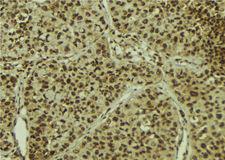 MGEA5 Antibody - 1:100 staining human breast carcinoma tissue by IHC-P. The sample was formaldehyde fixed and a heat mediated antigen retrieval step in citrate buffer was performed. The sample was then blocked and incubated with the antibody for 1.5 hours at 22°C. An HRP conjugated goat anti-rabbit antibody was used as the secondary.