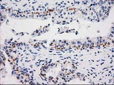 MGLL / Monoacylglycerol Lipase Antibody - IHC of paraffin-embedded Adenocarcinoma of Human ovary tissue using anti-MGLL mouse monoclonal antibody.