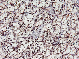 MGLL / Monoacylglycerol Lipase Antibody - IHC of paraffin-embedded Carcinoma of Human kidney tissue using anti-MGLL mouse monoclonal antibody.