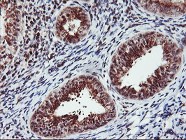 MGLL / Monoacylglycerol Lipase Antibody - IHC of paraffin-embedded Adenocarcinoma of Human endometrium tissue using anti-MGLL mouse monoclonal antibody.