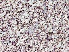 MGLL / Monoacylglycerol Lipase Antibody - IHC of paraffin-embedded Carcinoma of Human kidney tissue using anti-MGLL mouse monoclonal antibody.