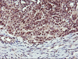 MGLL / Monoacylglycerol Lipase Antibody - IHC of paraffin-embedded Adenocarcinoma of Human ovary tissue using anti-MGLL mouse monoclonal antibody.
