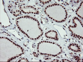 MGLL / Monoacylglycerol Lipase Antibody - IHC of paraffin-embedded Carcinoma of Human thyroid tissue using anti-MGLL mouse monoclonal antibody.