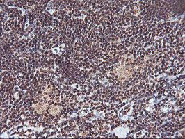 MGLL / Monoacylglycerol Lipase Antibody - IHC of paraffin-embedded Human lymphoma tissue using anti-MGLL mouse monoclonal antibody.