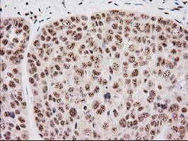 MGLL / Monoacylglycerol Lipase Antibody - IHC of paraffin-embedded Adenocarcinoma of Human breast tissue using anti-MGLL mouse monoclonal antibody. (Heat-induced epitope retrieval by 10mM citric buffer, pH6.0, 100C for 10min).