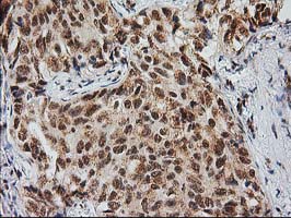 MGLL / Monoacylglycerol Lipase Antibody - IHC of paraffin-embedded Carcinoma of Human lung tissue using anti-MGLL mouse monoclonal antibody. (Heat-induced epitope retrieval by 10mM citric buffer, pH6.0, 100C for 10min).