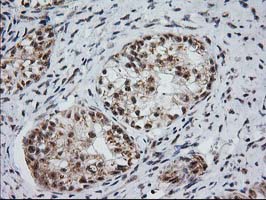 MGLL / Monoacylglycerol Lipase Antibody - IHC of paraffin-embedded Adenocarcinoma of Human ovary tissue using anti-MGLL mouse monoclonal antibody. (Heat-induced epitope retrieval by 10mM citric buffer, pH6.0, 100C for 10min).