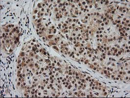 MGLL / Monoacylglycerol Lipase Antibody - IHC of paraffin-embedded Carcinoma of Human pancreas tissue using anti-MGLL mouse monoclonal antibody. (Heat-induced epitope retrieval by 10mM citric buffer, pH6.0, 100C for 10min).