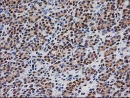 MGLL / Monoacylglycerol Lipase Antibody - IHC of paraffin-embedded Carcinoma of Human thyroid tissue using anti-MGLL mouse monoclonal antibody. (Heat-induced epitope retrieval by 10mM citric buffer, pH6.0, 100C for 10min).