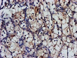 MGLL / Monoacylglycerol Lipase Antibody - IHC of paraffin-embedded Carcinoma of Human kidney tissue using anti-MGLL mouse monoclonal antibody.