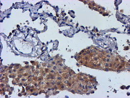 MGLL / Monoacylglycerol Lipase Antibody - IHC of paraffin-embedded Carcinoma of Human lung tissue using anti-MGLL mouse monoclonal antibody.