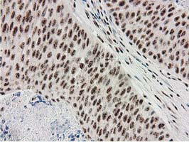 MGLL / Monoacylglycerol Lipase Antibody - IHC of paraffin-embedded Carcinoma of Human bladder tissue using anti-MGLL mouse monoclonal antibody. (Heat-induced epitope retrieval by 10mM citric buffer, pH6.0, 100C for 10min).