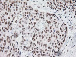 MGLL / Monoacylglycerol Lipase Antibody - IHC of paraffin-embedded Adenocarcinoma of Human breast tissue using anti-MGLL mouse monoclonal antibody. (Heat-induced epitope retrieval by 10mM citric buffer, pH6.0, 100C for 10min).