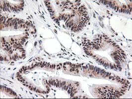 MGLL / Monoacylglycerol Lipase Antibody - IHC of paraffin-embedded Adenocarcinoma of Human colon tissue using anti-MGLL mouse monoclonal antibody. (Heat-induced epitope retrieval by 10mM citric buffer, pH6.0, 100C for 10min).