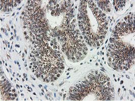MGLL / Monoacylglycerol Lipase Antibody - IHC of paraffin-embedded Adenocarcinoma of Human endometrium tissue using anti-MGLL mouse monoclonal antibody. (Heat-induced epitope retrieval by 10mM citric buffer, pH6.0, 100C for 10min).