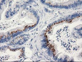 MGLL / Monoacylglycerol Lipase Antibody - IHC of paraffin-embedded Adenocarcinoma of Human colon tissue using anti-MGLL mouse monoclonal antibody.