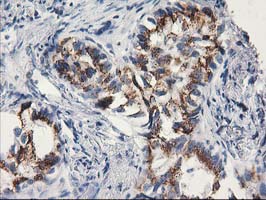 MGLL / Monoacylglycerol Lipase Antibody - IHC of paraffin-embedded Carcinoma of Human lung tissue using anti-MGLL mouse monoclonal antibody.