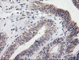 MGLL / Monoacylglycerol Lipase Antibody - IHC of paraffin-embedded Adenocarcinoma of Human endometrium tissue using anti-MGLL mouse monoclonal antibody.