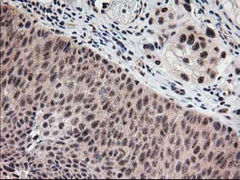 MGLL / Monoacylglycerol Lipase Antibody - IHC of paraffin-embedded Carcinoma of Human bladder tissue using anti-MGLL mouse monoclonal antibody.