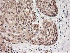 MGLL / Monoacylglycerol Lipase Antibody - IHC of paraffin-embedded Adenocarcinoma of Human breast tissue using anti-MGLL mouse monoclonal antibody.