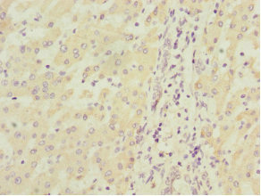 MGLL / Monoacylglycerol Lipase Antibody - Immunohistochemistry of paraffin-embedded human liver cancer at dilution 1:100