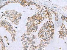 MGME1 / C20orf72 Antibody - Immunohistochemistry of paraffin-embedded Human gastric cancer tissue  using MGME1 Polyclonal Antibody at dilution of 1:70(×200)