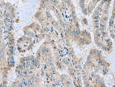 MGME1 / C20orf72 Antibody - Immunohistochemistry of paraffin-embedded Human thyroid cancer tissue  using MGME1 Polyclonal Antibody at dilution of 1:50(×200)