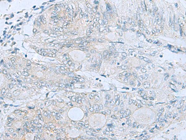 MGME1 / C20orf72 Antibody - Immunohistochemistry of paraffin-embedded Human colorectal cancer tissue  using MGME1 Polyclonal Antibody at dilution of 1:50(×200)