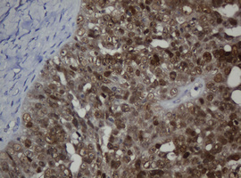 MGMT Antibody - IHC of paraffin-embedded Adenocarcinoma of Human ovary tissue using anti-MGMT mouse monoclonal antibody.