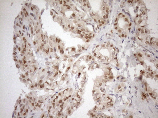MGMT Antibody - Immunohistochemical staining of paraffin-embedded Carcinoma of Human thyroid tissue using anti-MGMT mouse monoclonal antibody. (Heat-induced epitope retrieval by 1mM EDTA in 10mM Tris buffer. (pH8.5) at 120°C for 3 min. (1:150)