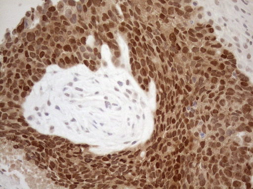 MGMT Antibody - Immunohistochemical staining of paraffin-embedded Adenocarcinoma of Human endometrium tissue using anti-MGMT mouse monoclonal antibody. (Heat-induced epitope retrieval by 1mM EDTA in 10mM Tris buffer. (pH8.5) at 120°C for 3 min. (1:150)