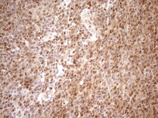 MGMT Antibody - Immunohistochemical staining of paraffin-embedded Human lymphoma tissue using anti-MGMT mouse monoclonal antibody. (Heat-induced epitope retrieval by 1mM EDTA in 10mM Tris buffer. (pH8.5) at 120°C for 3 min. (1:150)