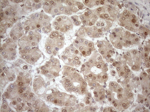 MGMT Antibody - Immunohistochemical staining of paraffin-embedded Carcinoma of Human liver tissue using anti-MGMT mouse monoclonal antibody. (Heat-induced epitope retrieval by 1mM EDTA in 10mM Tris buffer. (pH8.5) at 120°C for 3 min. (1:150)