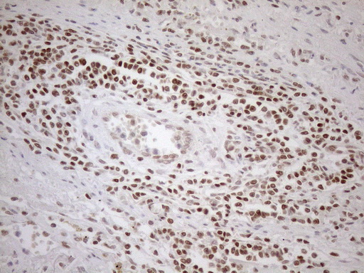 MGMT Antibody - Immunohistochemical staining of paraffin-embedded Carcinoma of Human lung tissue using anti-MGMT mouse monoclonal antibody. (Heat-induced epitope retrieval by 1mM EDTA in 10mM Tris buffer. (pH8.5) at 120°C for 3 min. (1:150)