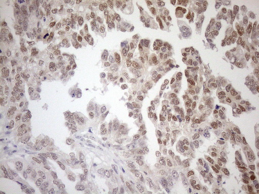 MGMT Antibody - Immunohistochemical staining of paraffin-embedded Adenocarcinoma of Human ovary tissue using anti-MGMT mouse monoclonal antibody. (Heat-induced epitope retrieval by 1mM EDTA in 10mM Tris buffer. (pH8.5) at 120°C for 3 min. (1:150)