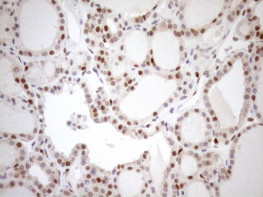 MGMT Antibody - Immunohistochemical staining of paraffin-embedded Human thyroid tissue within the normal limits using anti-MGMT mouse monoclonal antibody. (Heat-induced epitope retrieval by 1mM EDTA in 10mM Tris buffer. (pH8.5) at 120°C for 3 min. (1:150)