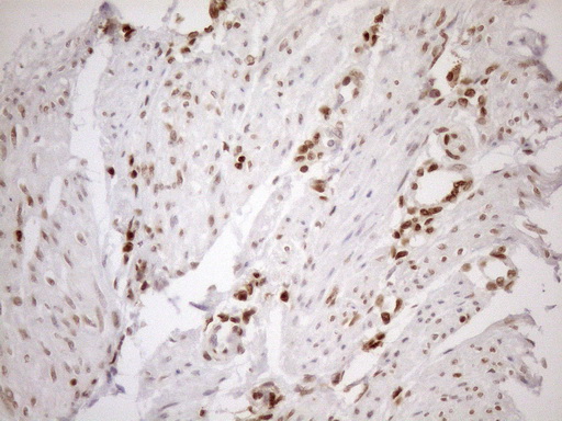 MGMT Antibody - Immunohistochemical staining of paraffin-embedded Human endometrium tissue within the normal limits using anti-MGMT mouse monoclonal antibody. (Heat-induced epitope retrieval by 1mM EDTA in 10mM Tris buffer. (pH8.5) at 120°C for 3 min. (1:150)