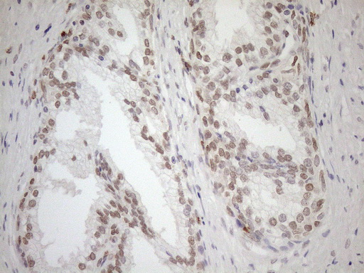 MGMT Antibody - Immunohistochemical staining of paraffin-embedded Human prostate tissue within the normal limits using anti-MGMT mouse monoclonal antibody. (Heat-induced epitope retrieval by 1mM EDTA in 10mM Tris buffer. (pH8.5) at 120°C for 3 min. (1:150)