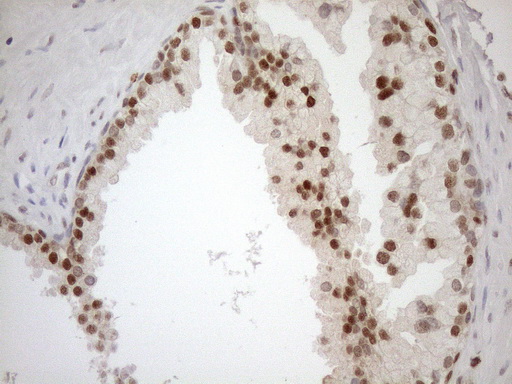 MGMT Antibody - Immunohistochemical staining of paraffin-embedded Carcinoma of Human prostate tissue using anti-MGMT mouse monoclonal antibody. (Heat-induced epitope retrieval by 1mM EDTA in 10mM Tris buffer. (pH8.5) at 120°C for 3 min. (1:150)