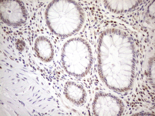 MGMT Antibody - Immunohistochemical staining of paraffin-embedded Human colon tissue within the normal limits using anti-MGMT mouse monoclonal antibody. (Heat-induced epitope retrieval by 1mM EDTA in 10mM Tris buffer. (pH8.5) at 120°C for 3 min. (1:150)