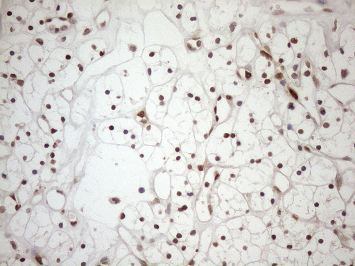 MGMT Antibody - Immunohistochemical staining of paraffin-embedded Carcinoma of Human kidney tissue using anti-MGMT mouse monoclonal antibody. (Heat-induced epitope retrieval by 1mM EDTA in 10mM Tris buffer. (pH8.5) at 120°C for 3 min. (1:150)