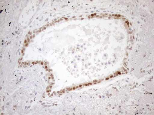 MGMT Antibody - Immunohistochemical staining of paraffin-embedded Carcinoma of Human lung tissue using anti-MGMT mouse monoclonal antibody. (Heat-induced epitope retrieval by 1mM EDTA in 10mM Tris buffer. (pH8.5) at 120°C for 3 min. (1:150)