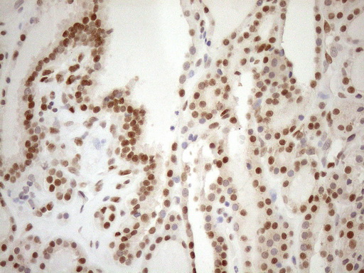 MGMT Antibody - Immunohistochemical staining of paraffin-embedded Human thyroid tissue within the normal limits using anti-MGMT mouse monoclonal antibody. (Heat-induced epitope retrieval by 1mM EDTA in 10mM Tris buffer. (pH8.5) at 120°C for 3 min. (1:150)